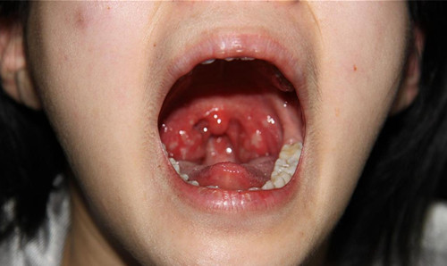 口臭、打鼾、嗓子疼，原来都是这一个原因造成的！