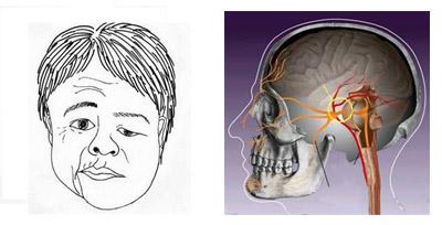 孕妇为什么得了吊线风,孕期得吊线风怎么办