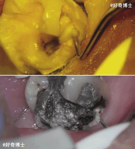 蛀牙会散发臭味吗,抠蛀牙洞臭