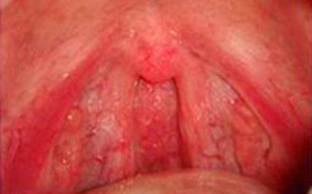 咽喉炎怎么治疗除根,万应胶囊治疗咽喉炎