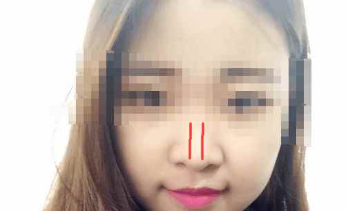 有多少人隆鼻后悔了,隆鼻的十大猫腻