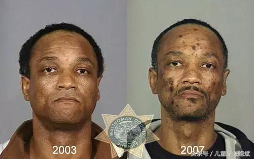 如何从牙齿上判断小孩是否铅中毒,大人口腔细菌对宝宝危害真实案例