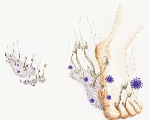 香港脚通过什么传染,大人有香港脚会传染给宝宝吗