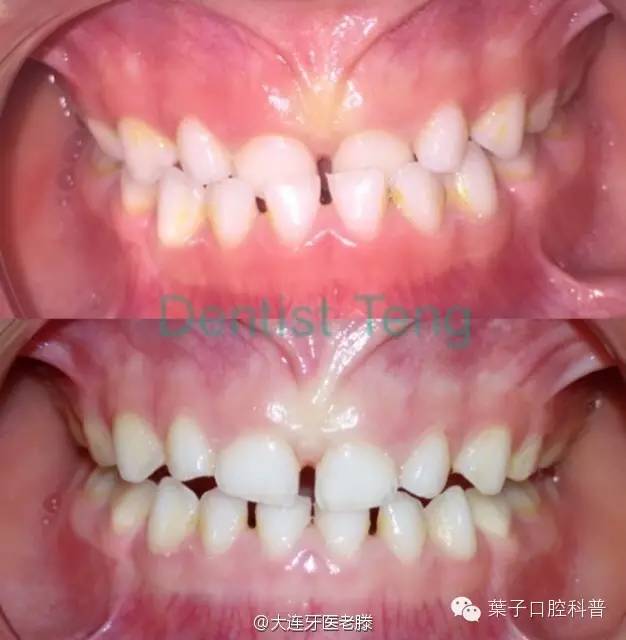 儿童反颌矫正的年龄及步骤,儿童反颌偏颌矫正案例