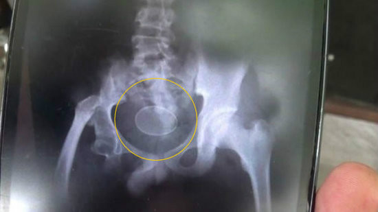 杭州男子肛门被塞20公分长振动棒称年会被恶搞(图