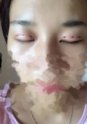 韩式三点双眼皮恢复单眼皮,韩式三点式双眼皮是永久性的吗