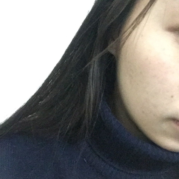 变美还是要祛痘,变美第一步祛痘