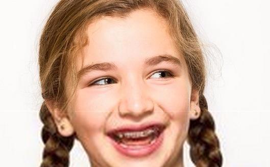 牙齿矫正的认知,矫正牙齿需要了解的知识