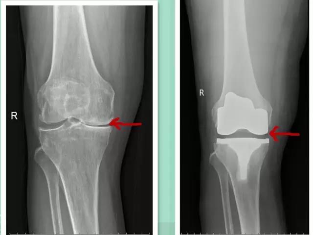且行且珍惜保护膝盖的动作,退行性膝关节病中医治疗方法