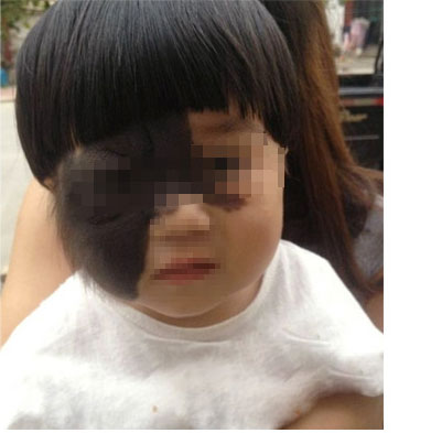 千奇百怪的胎记,各类胎记