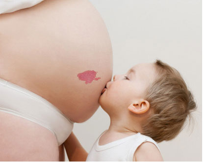 千奇百怪的胎记,各类胎记