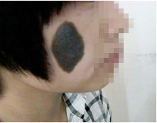 千奇百怪的胎记,各类胎记