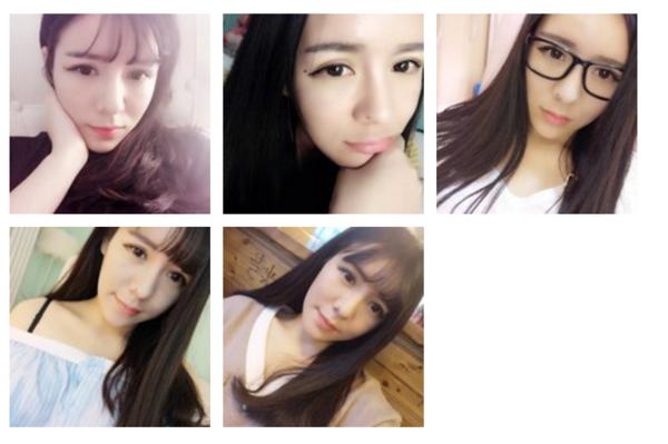 鼻子玻尿酸对比图,玻尿酸填充鼻子变宽后的图片