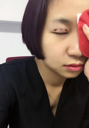 韩式三点双眼皮恢复单眼皮,韩式三点式双眼皮是永久性的吗