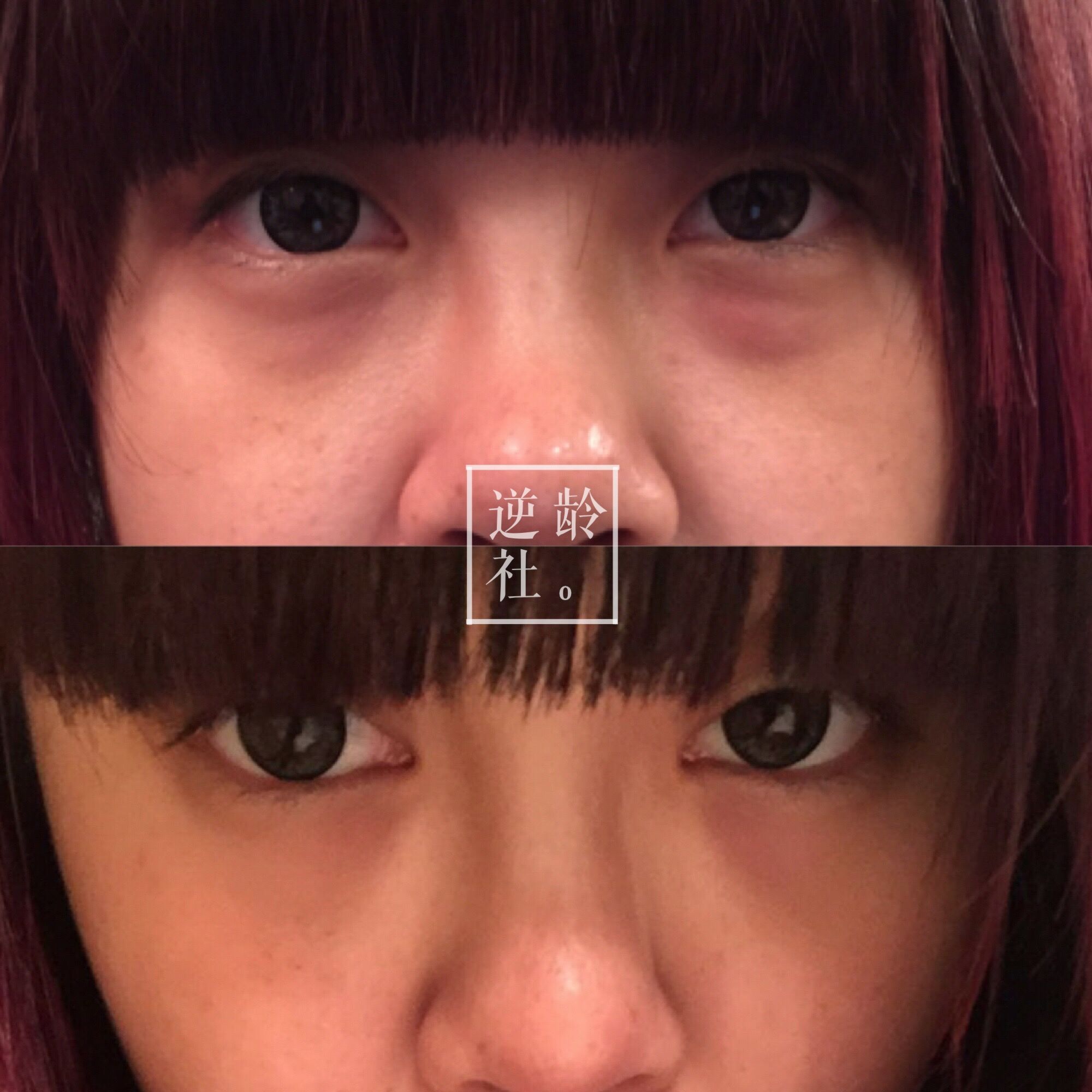 逆龄精雕好还是超声刀好,35岁做超声刀效果好吗