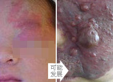 千奇百怪的胎记,各类胎记