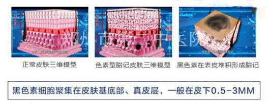 为什么说靠药品去除不了胎记