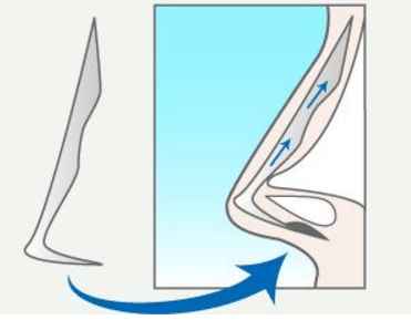 鼻假体用什么材料最好,鼻假体都有什么型