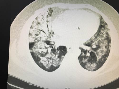发烧三天进抢救室,重症监护室发热