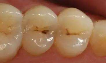 龋齿小洞不补,小洞不补大洞受苦是破窗效应吗