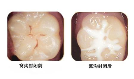 龋齿小洞不补,小洞不补大洞受苦是破窗效应吗