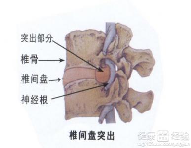 腰椎间盘突出你不了解的四件事,腰椎间盘突出这四点一定要注意