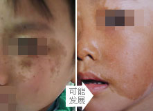 千奇百怪的胎记,各类胎记