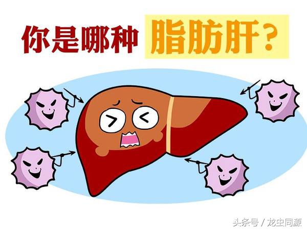 得了脂肪肝不需要紧张,有脂肪肝怎样才能不被检查出