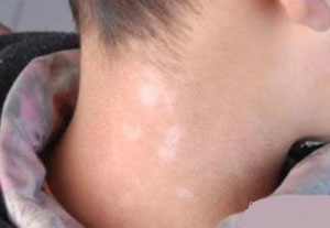 uvb和308治疗白癜风哪个效果好,家用308治疗白癜风哪个品牌好