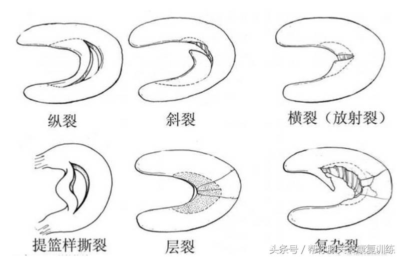 膝关节半月板损伤的最好治疗方法,膝关节半月板损伤症状和处理方法