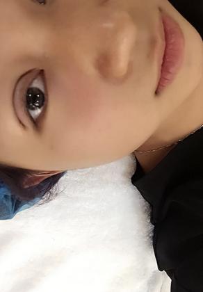 韩式三点双眼皮恢复单眼皮,韩式三点式双眼皮是永久性的吗