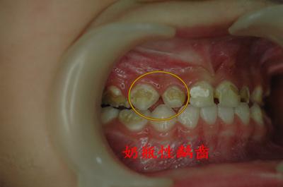 龋齿小洞不补,小洞不补大洞受苦是破窗效应吗