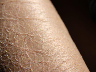 换季肌肤敏感脱皮怎么办,换季脸上脱皮干燥发痒