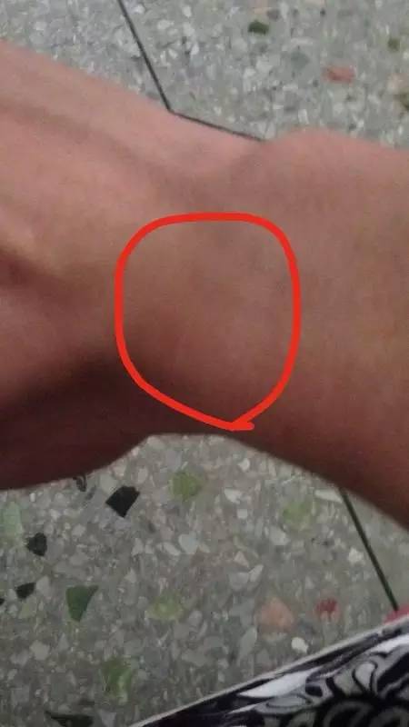 髌骨软骨软化的康复训练,髌骨软化如何讲解