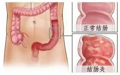 结肠炎反复拉肚子怎么办,结肠炎每天早上拉肚子下午不拉