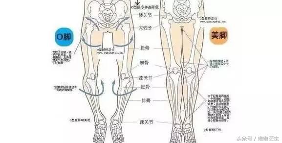 如何判断罗圈腿型,轻型罗圈腿怎样矫正