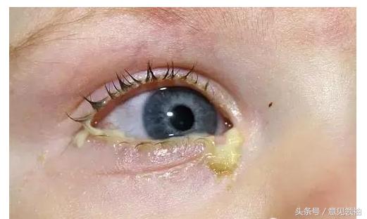 新冠红眼病有什么症状,羔羊红眼病的症状及治疗