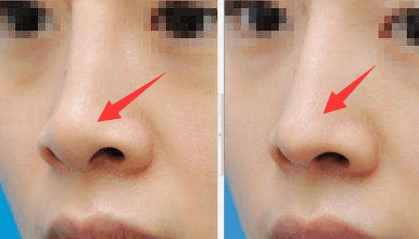 怎么按摩可缩小鼻头,鼻头肥大怎么按摩变小