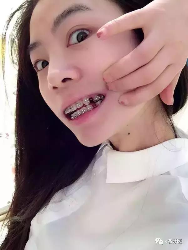 有牙洞并感觉到疼痛了,有牙洞很疼怎么办