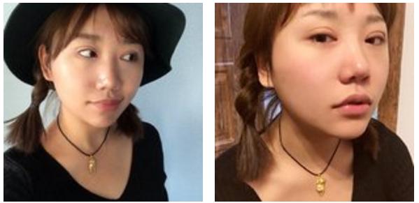 全切双眼皮会不会显老,全切双眼皮显老可以修复年轻吗