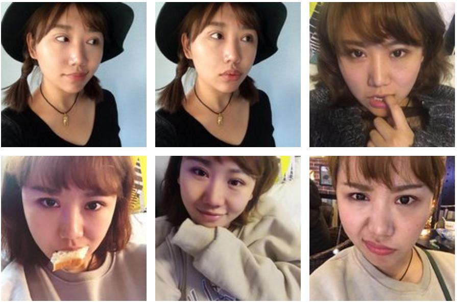 全切双眼皮会不会显老,全切双眼皮显老可以修复年轻吗