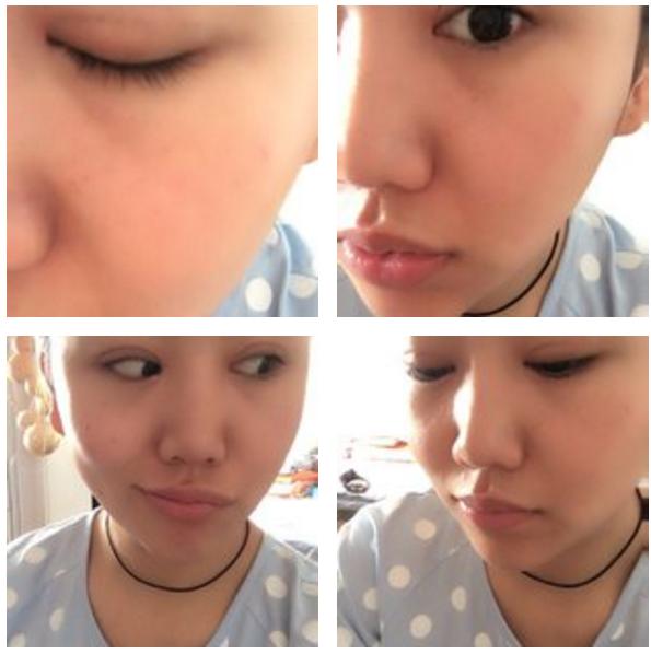 全切双眼皮会不会显老,全切双眼皮显老可以修复年轻吗