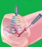 无创时代的产前筛查与产前诊断 (无创dna产前筛查)