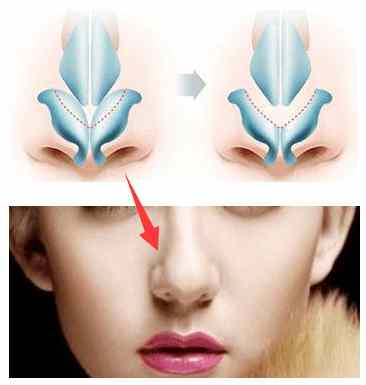 怎么按摩可缩小鼻头,鼻头肥大怎么按摩变小