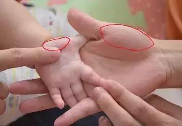 小儿推拿治疗小儿常见疾病