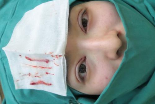 割双眼皮后多久可以吃辣,割双眼皮后多久可以吃辣椒