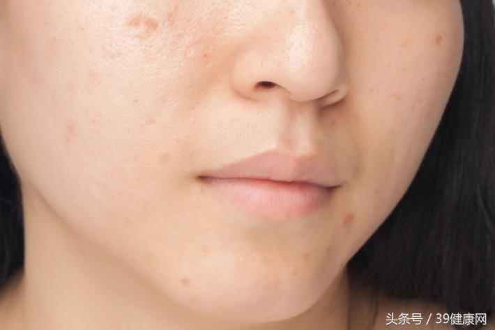 脸上为什么长斑怎样才能淡斑,脸上为什么长斑中医如何治疗