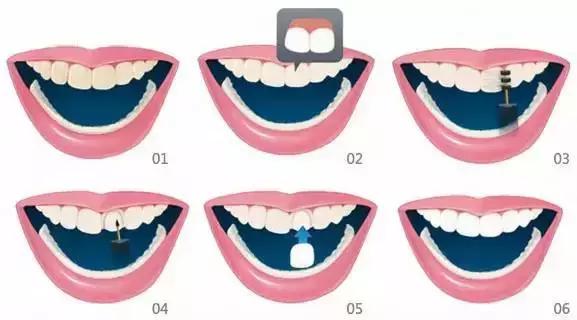 牙齿美白的必备干货,真正靠谱的牙齿美白方法