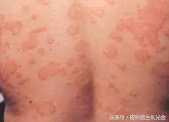 孕妇得了*麻疹荨**能不能用药？