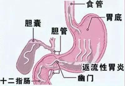 反流性食管炎,轻中度反流需要治疗吗